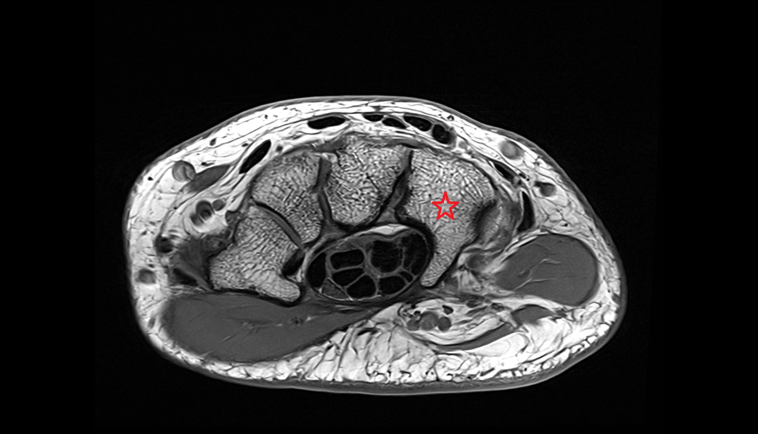 Hamate bone  bone axial cross sectional anatomy 3T MRI AI enhanced radiology image-img-00000-00000