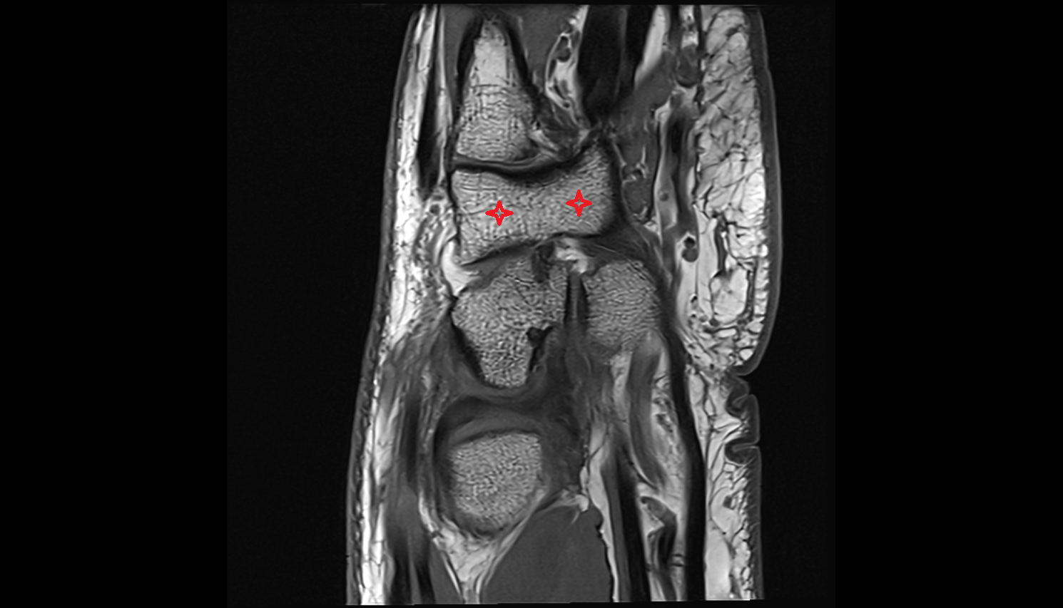 Hamate  bone coronal cross sectional anatomy 3T MRI AI enhanced radiology image-img-00000-00000_00001