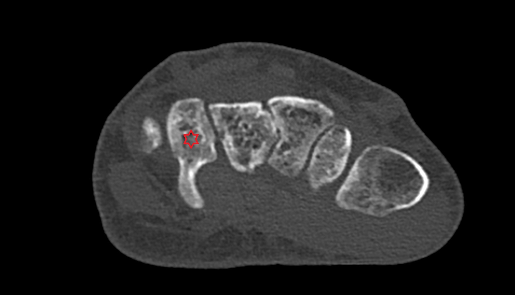 Hamate bone ct axial image