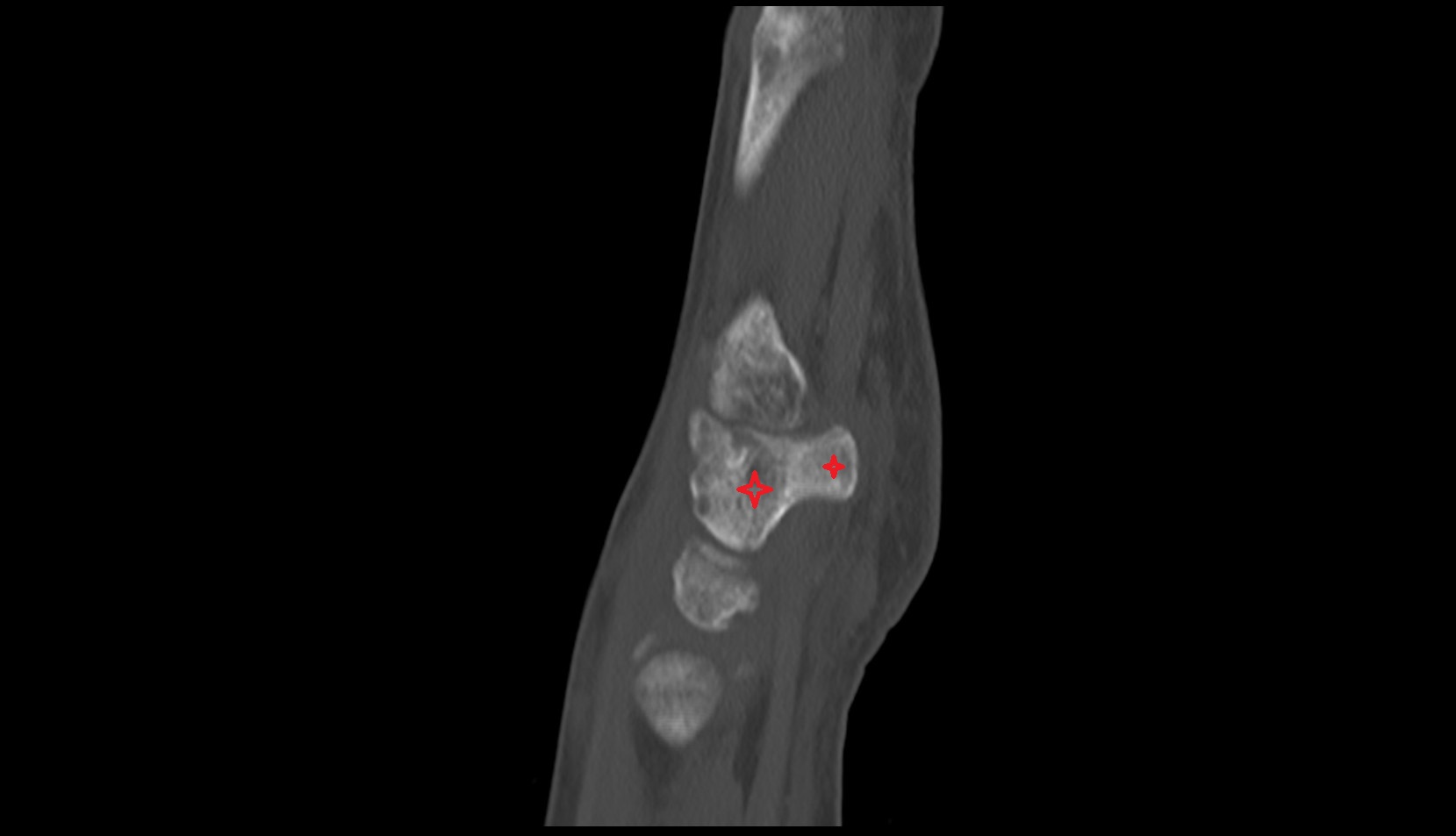 Hamate bone ct sagital image