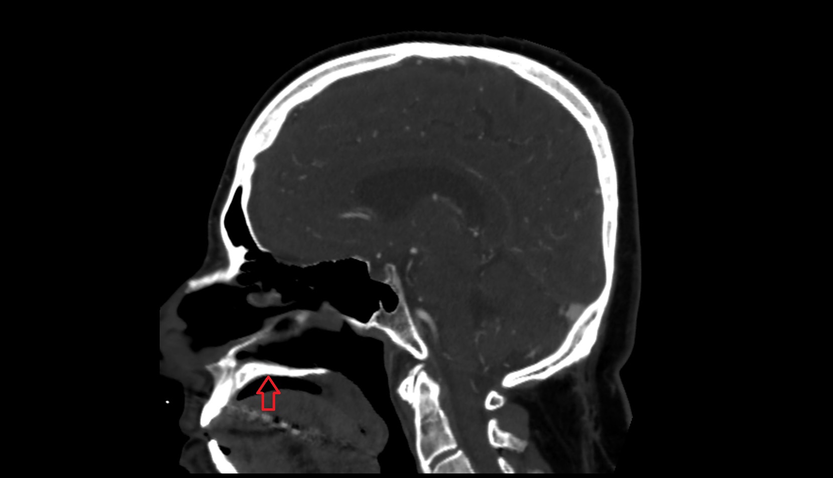 Hard palate ct sag image