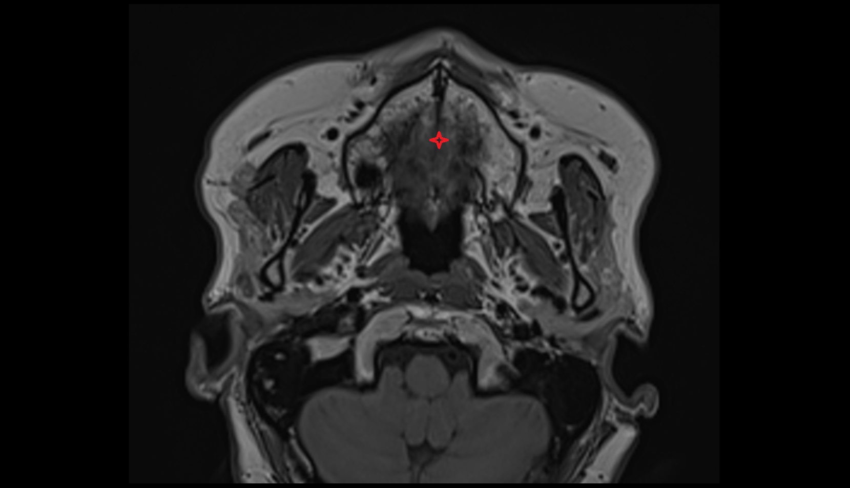 Hard palate mri axial image