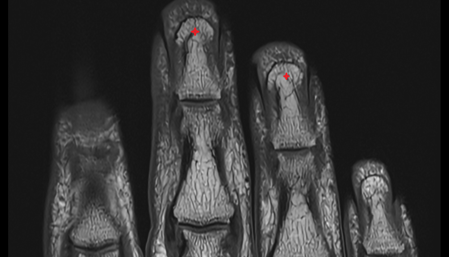 Head of distal phalanx  HAND  MRI CORONAL image-img-00000-00000
