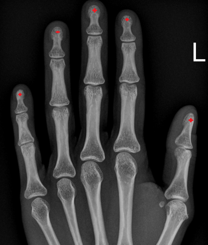 Head of distal phalanx bone