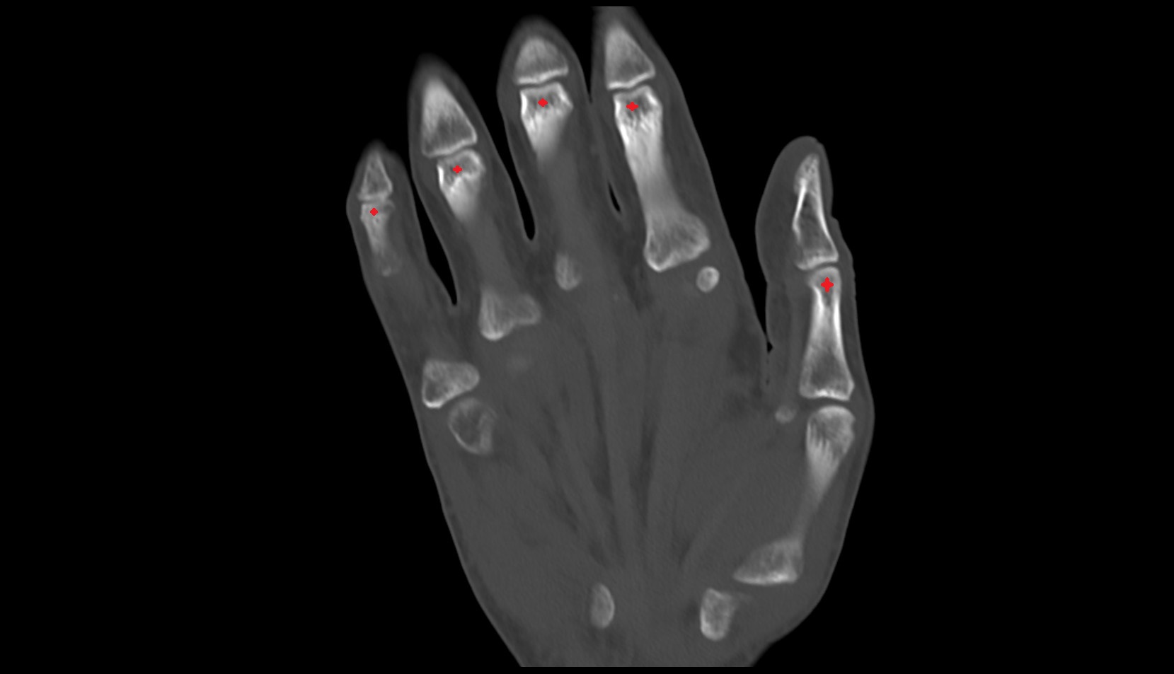 Head of distal phalanx coronal ct image