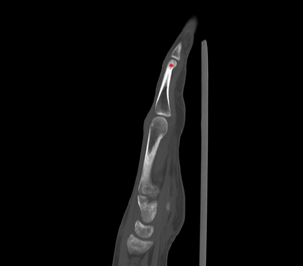 Head of distal phalanx sag image