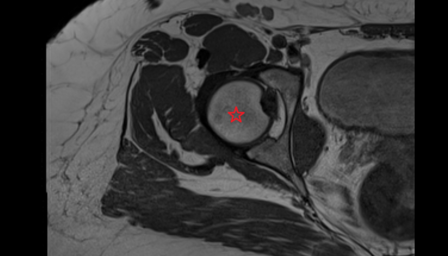 Head of femur  MRI  axial  anatomy  image