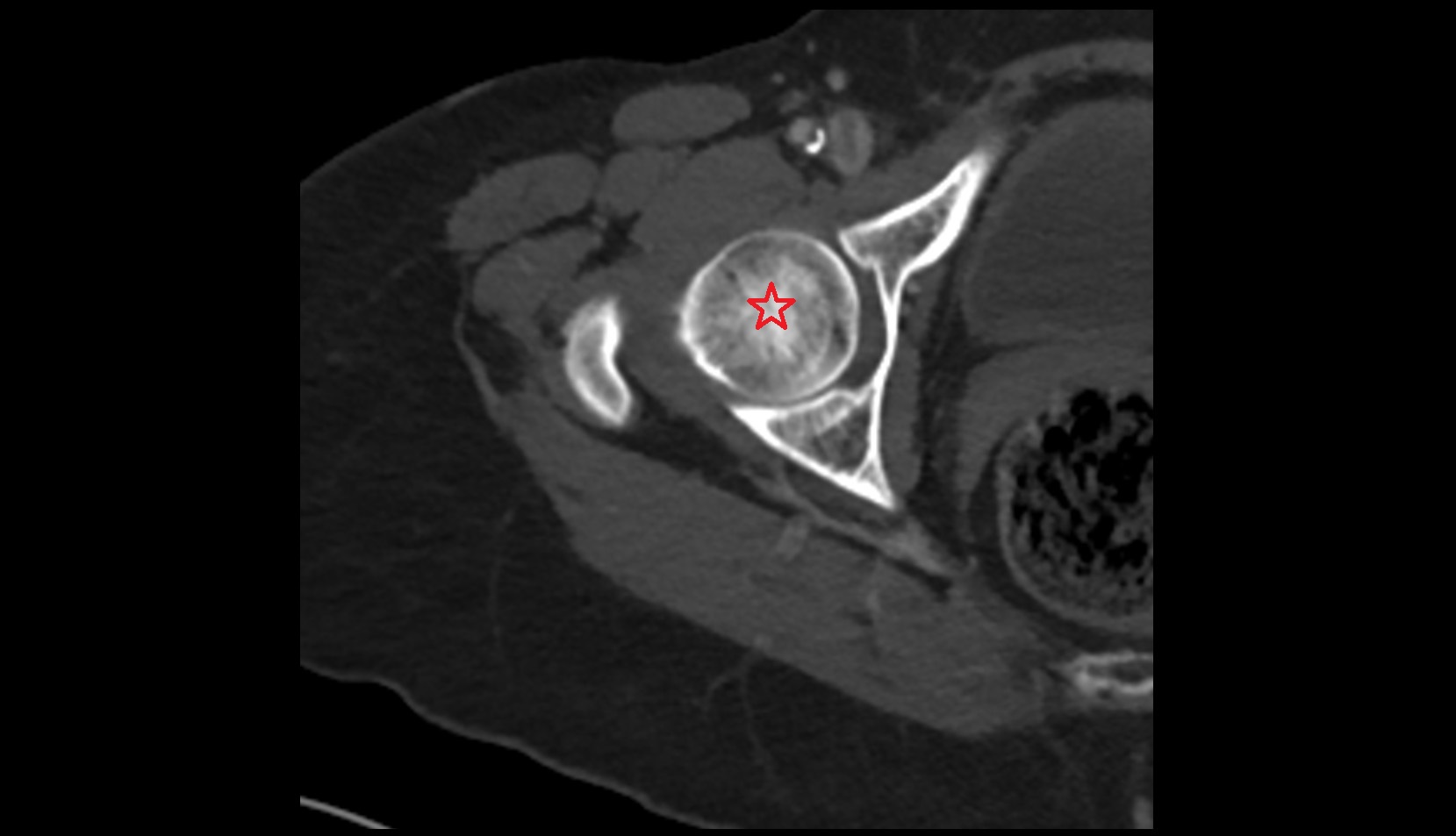 Head of femur ct axial image