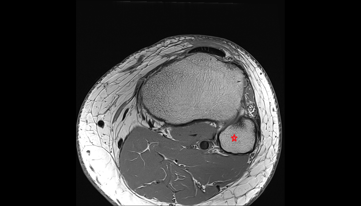 Head of fibula  axial cross sectional anatomy 3T MRI AI enhanced  radiology  anatomy image-img-00000-00000