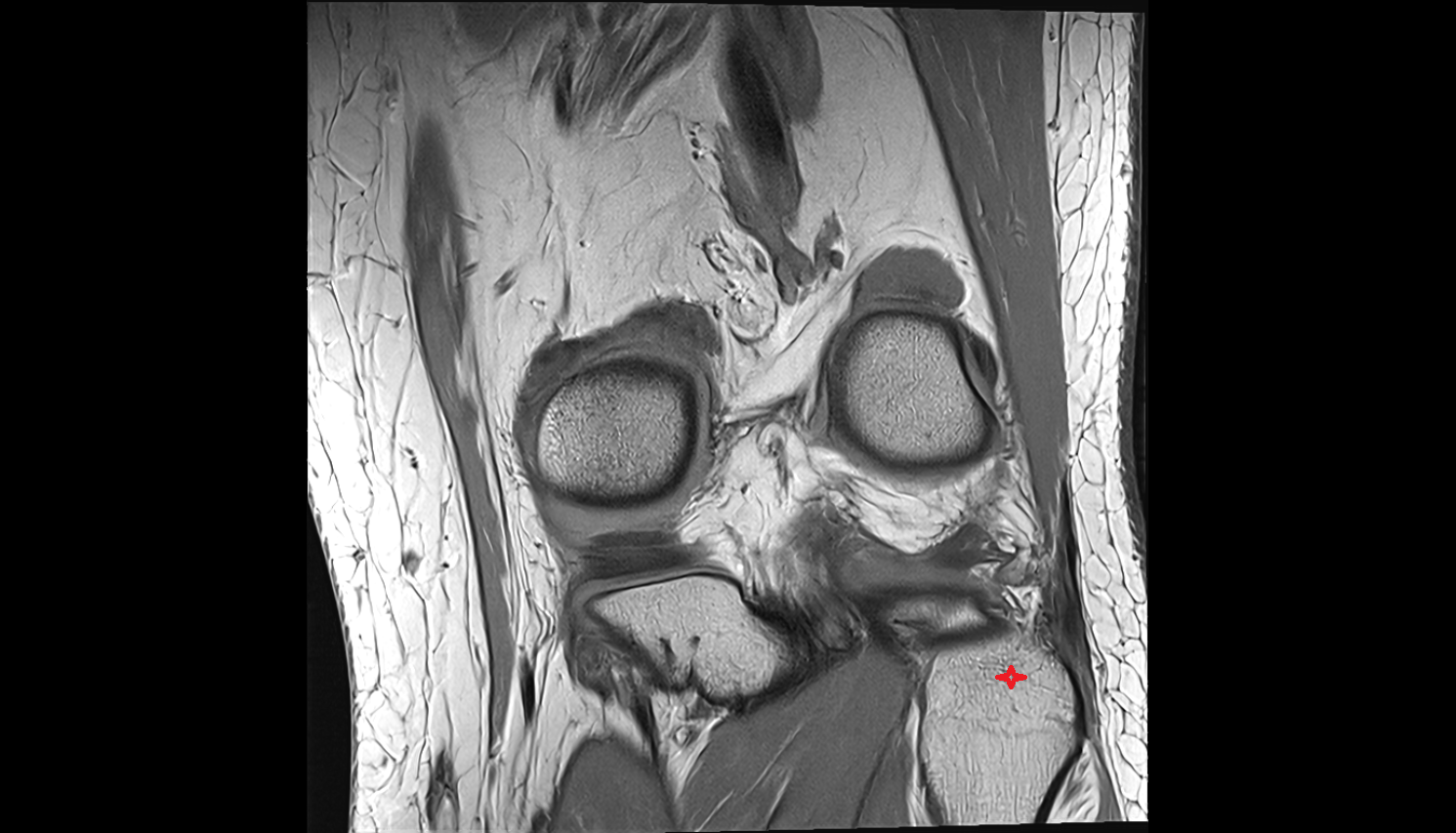 Head of fibula  coronal cross sectional anatomy 3T MRI AI enhanced  radiology  anatomy image-img-00000-00000