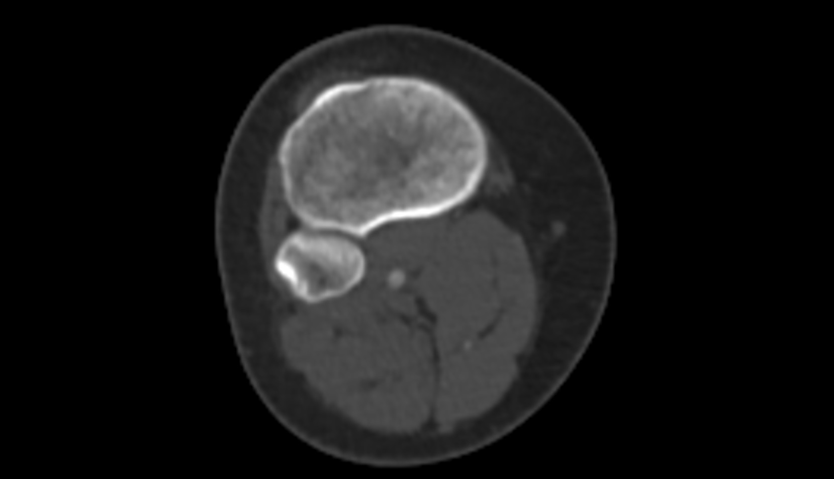 Head of fibula ct axial