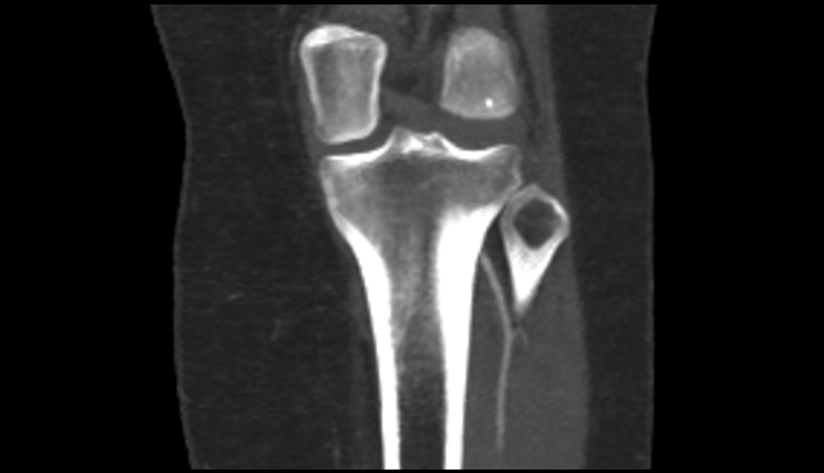 Head of fibula ct coronal image