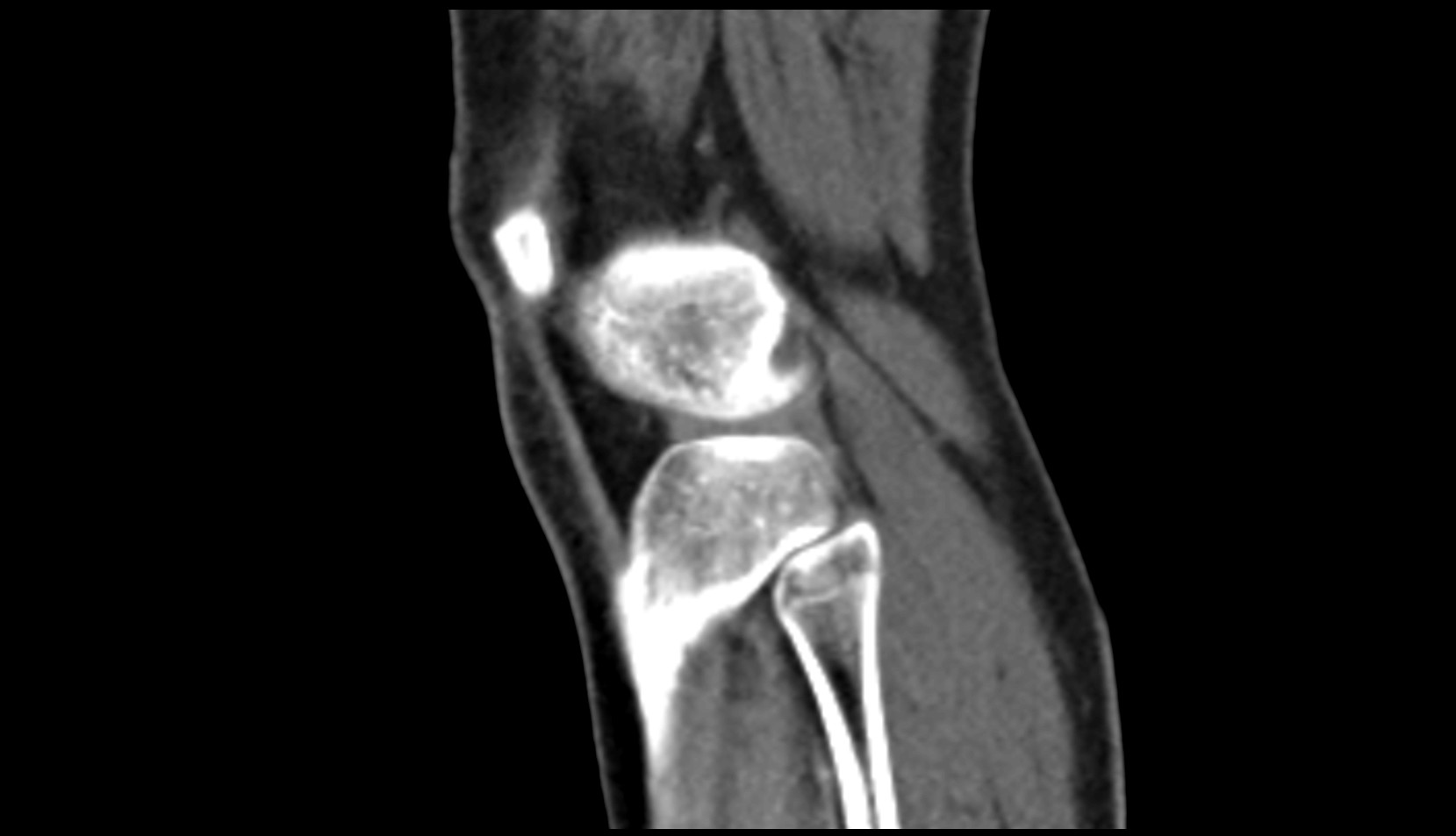 Head of fibula ct sag image