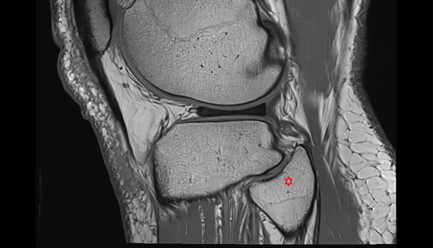 Head of fibula  sag cross sectional anatomy 3T MRI AI enhanced  radiology  anatomy image-img-00000-00000