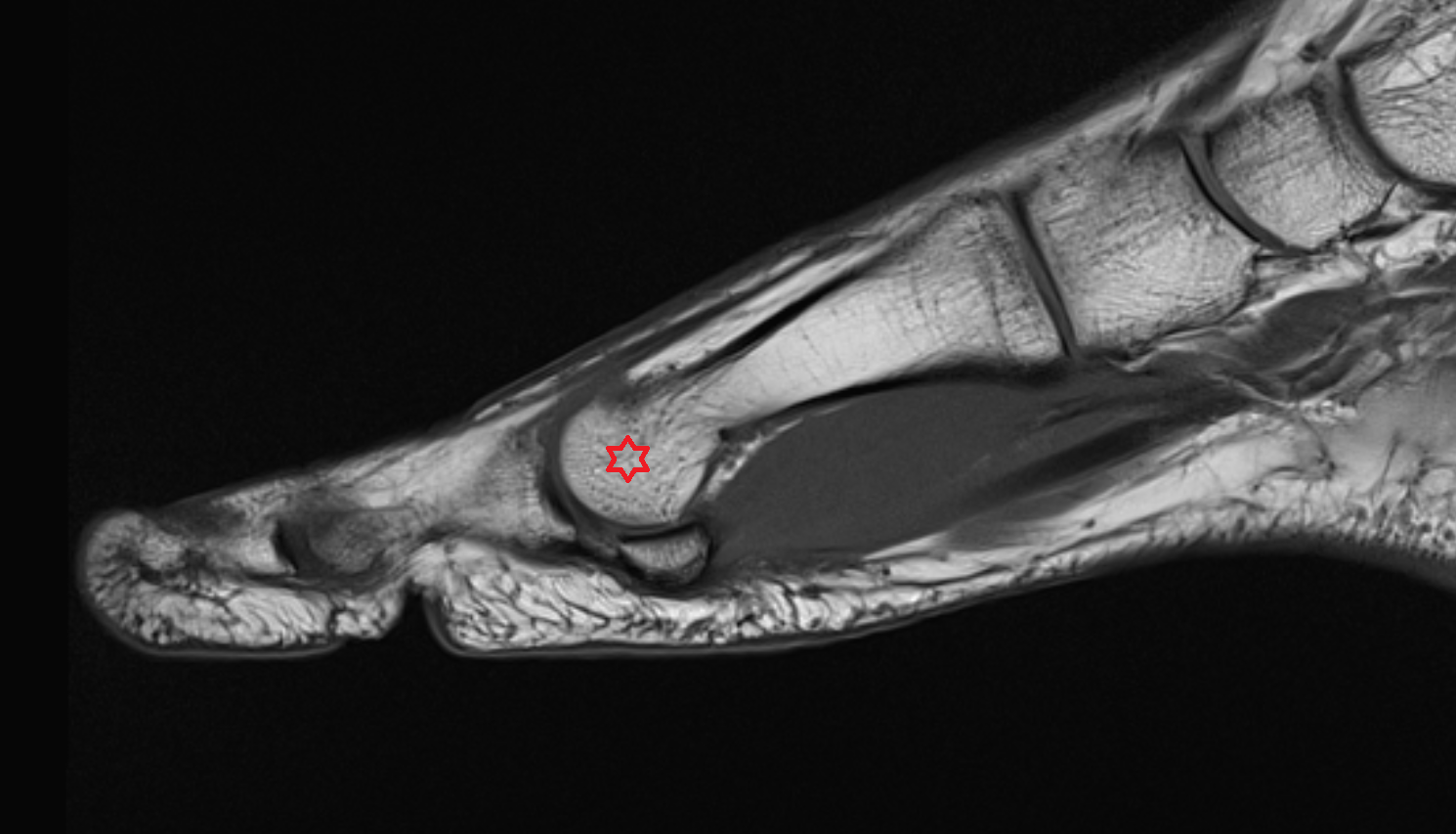 Head of first metatarsal bone mri  anatomy labelled image-img-00000-00000