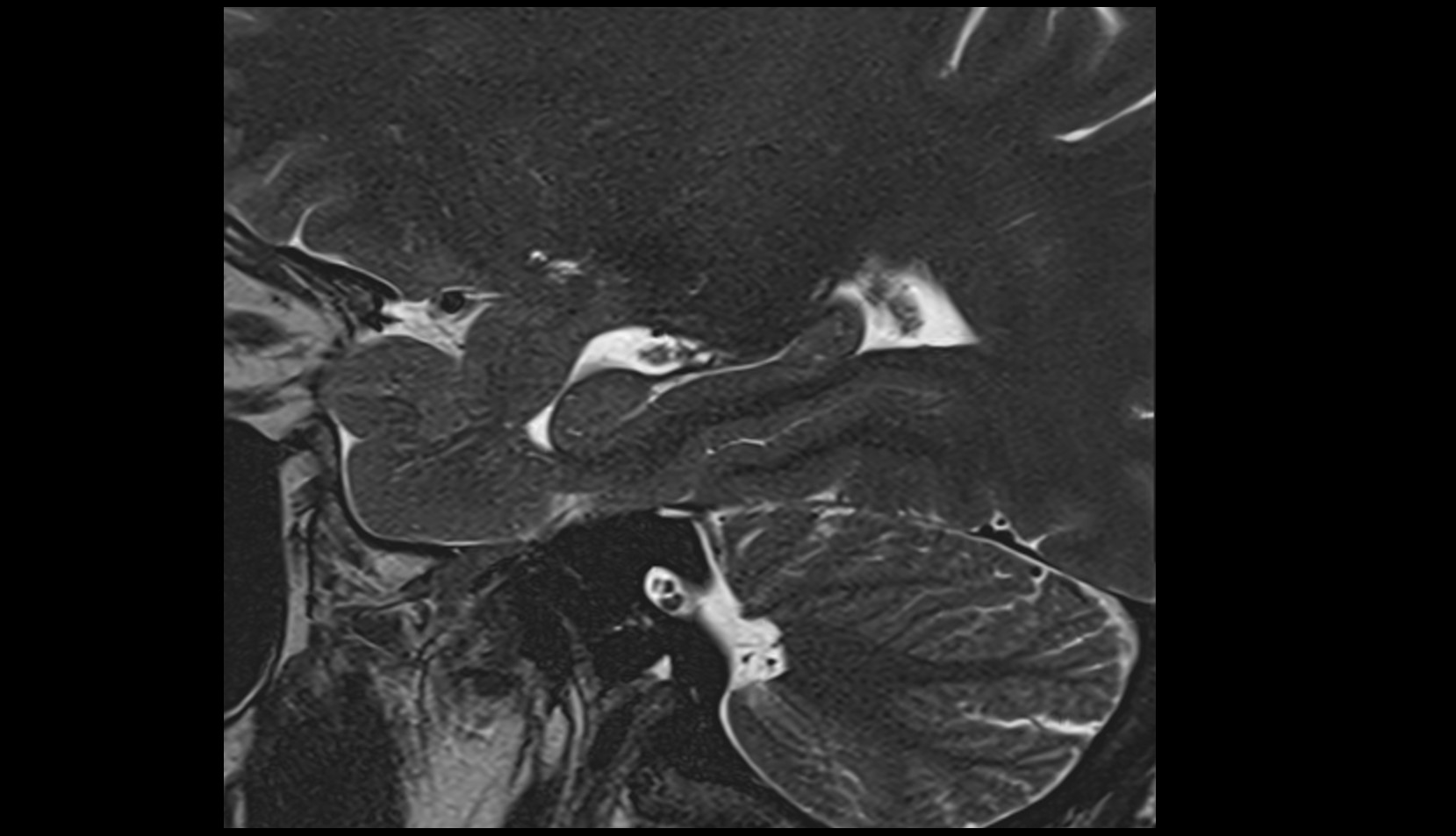 Head of hippocampus MRI IMAGE