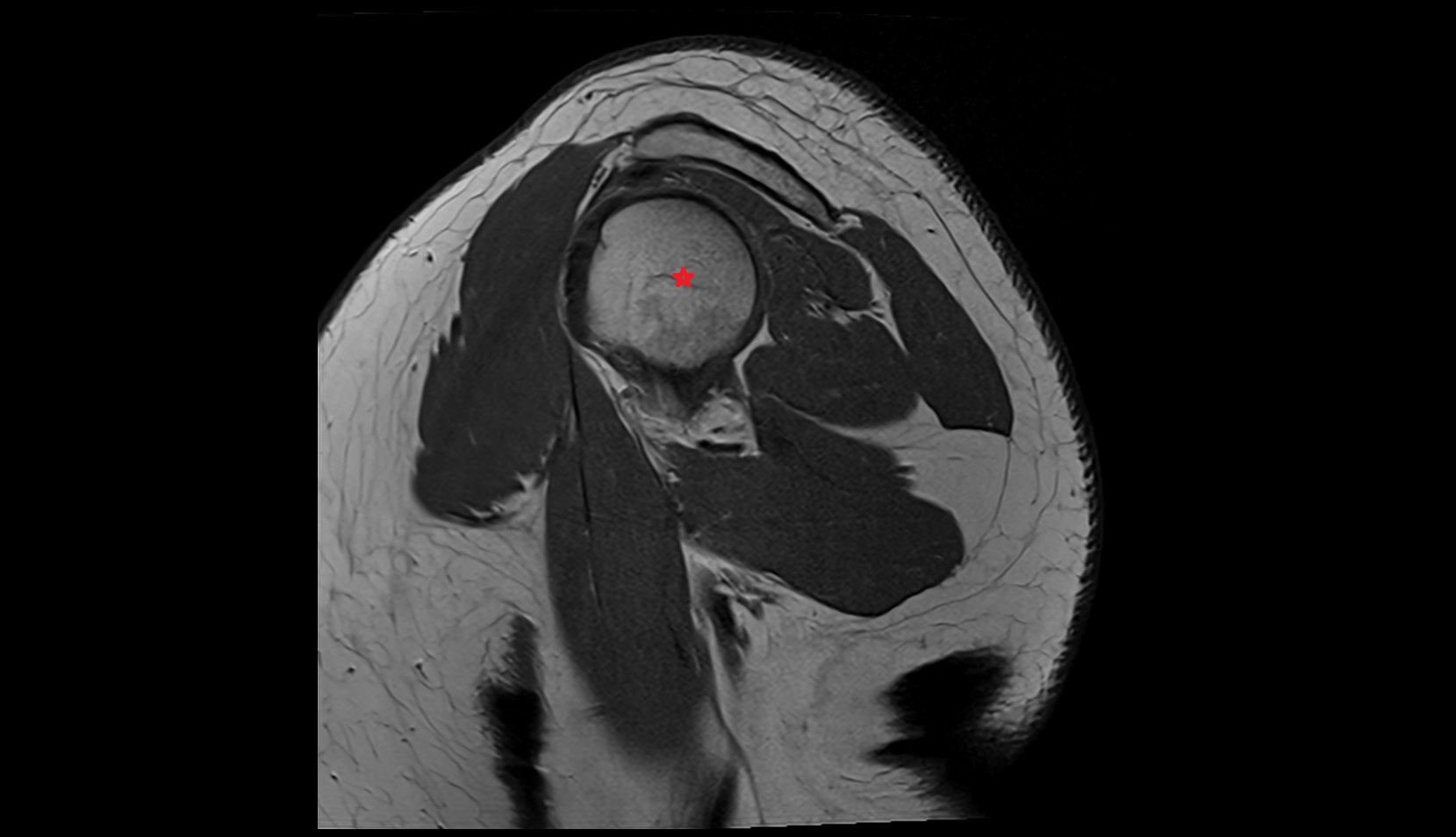 Head of humerus anatomy MRI SAG  image