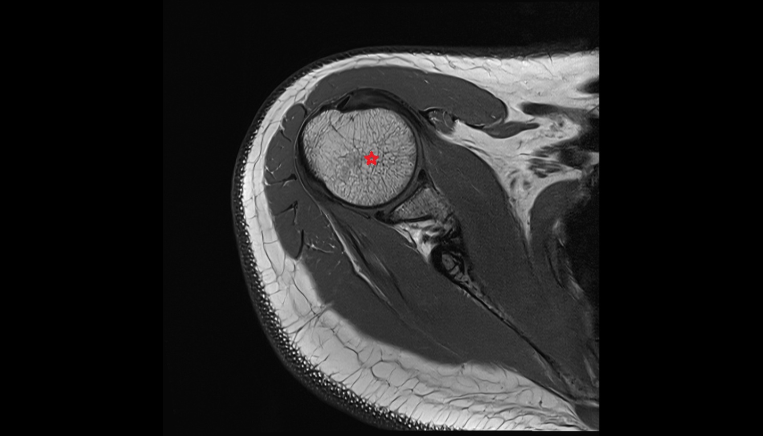 Head of humerus anatomy MRI axial  image -img-00000-00000