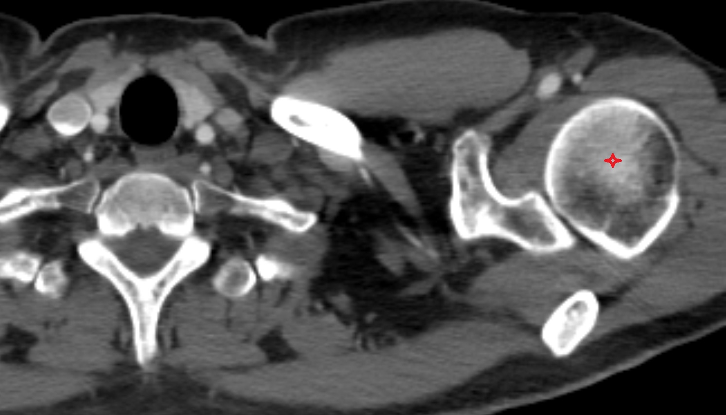 Head of humerus anatomy ct axial  image -img-00000-00000