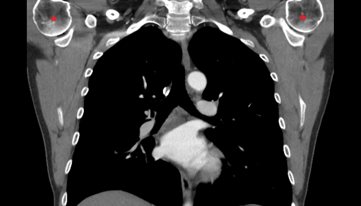 Head of humerus anatomy ct coronal  image -img-00000-00000