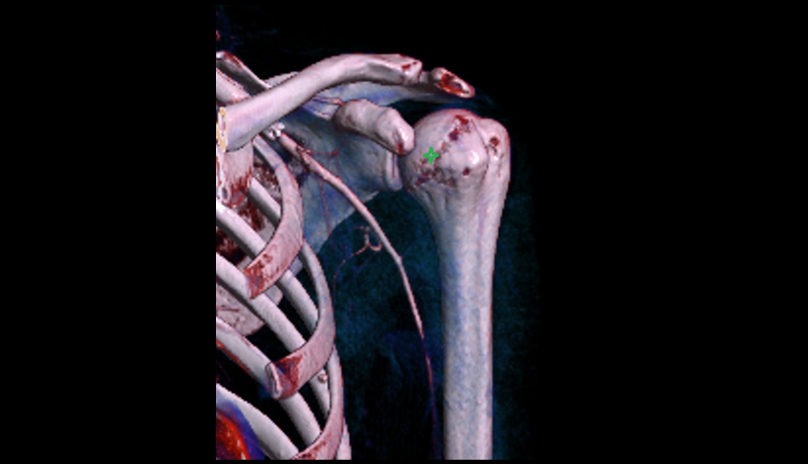 Head of humerus vrt image
