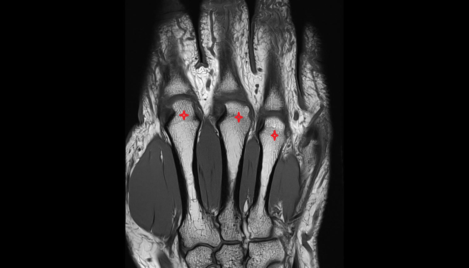 Head of metacarpal bone coronal cross sectional anatomy 3T MRI AI enhanced radiology image-img-00000-00000