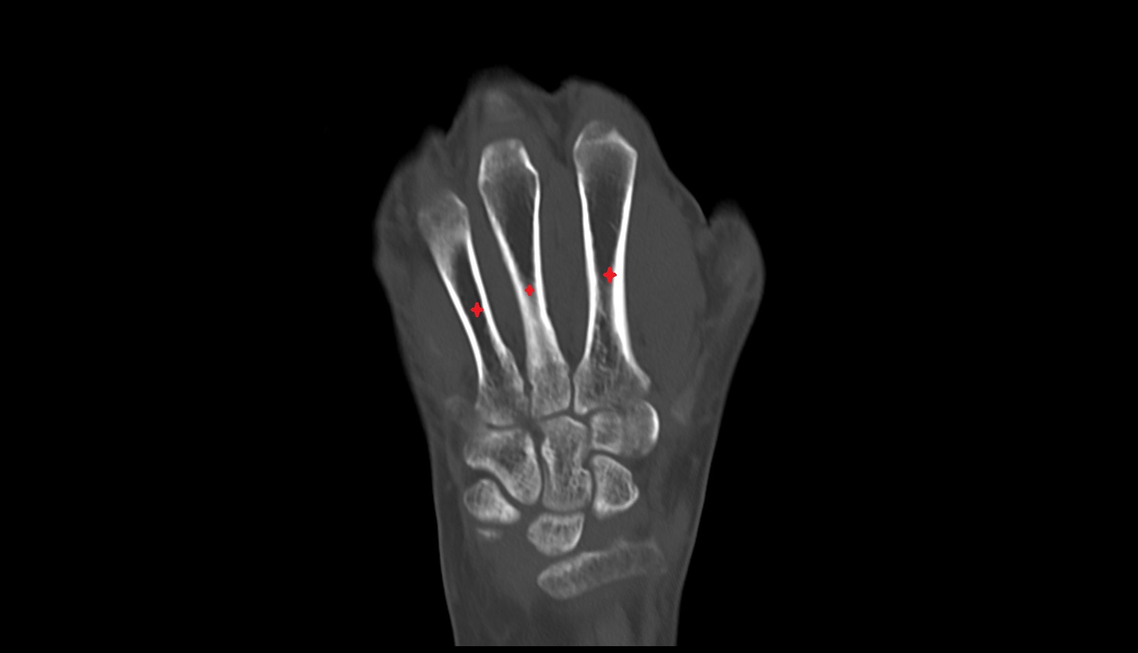 Head of metacarpal bone ct coronal image