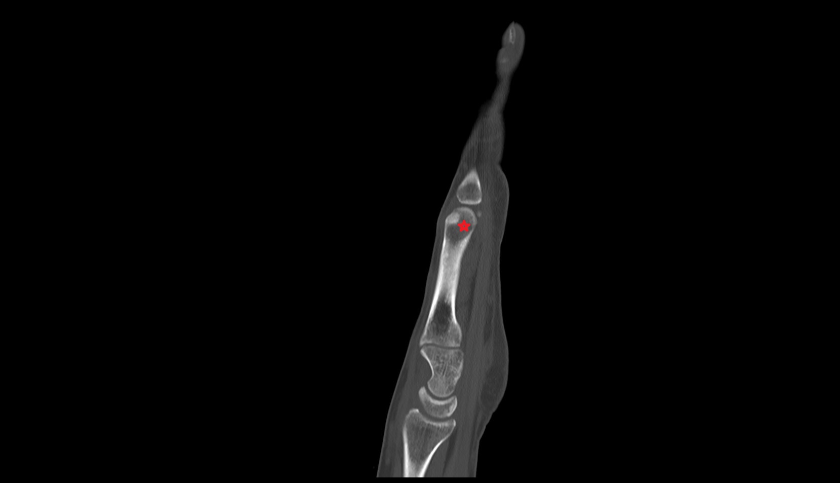 Head of metacarpal bone ct sag image