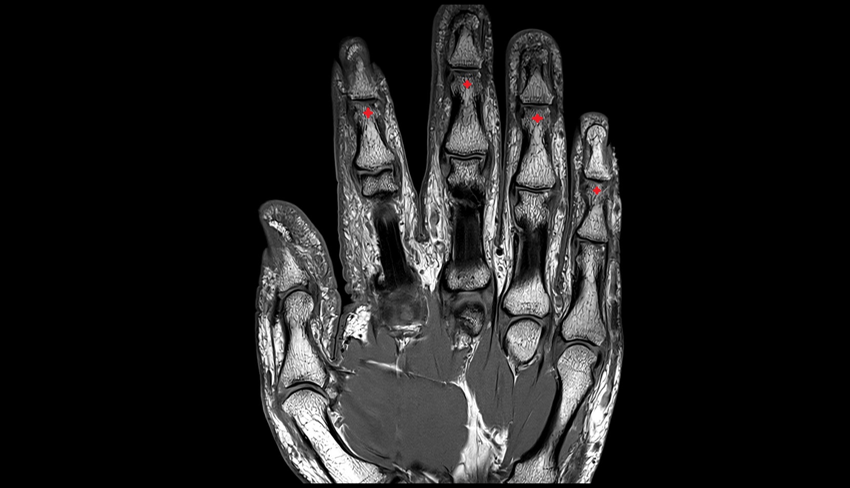Head of middle phalanx mri image
