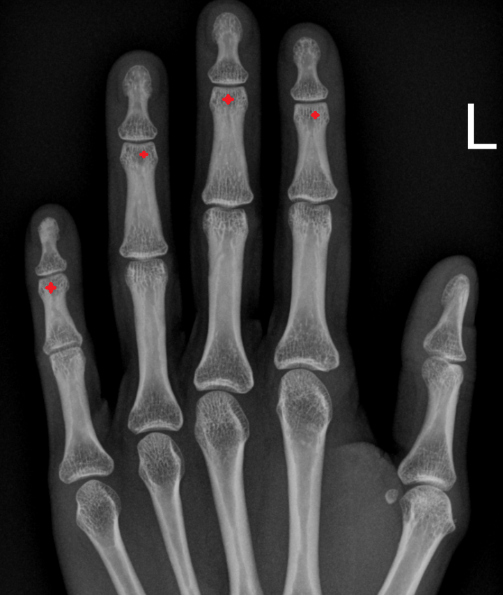 Head of middle phalanx x ray