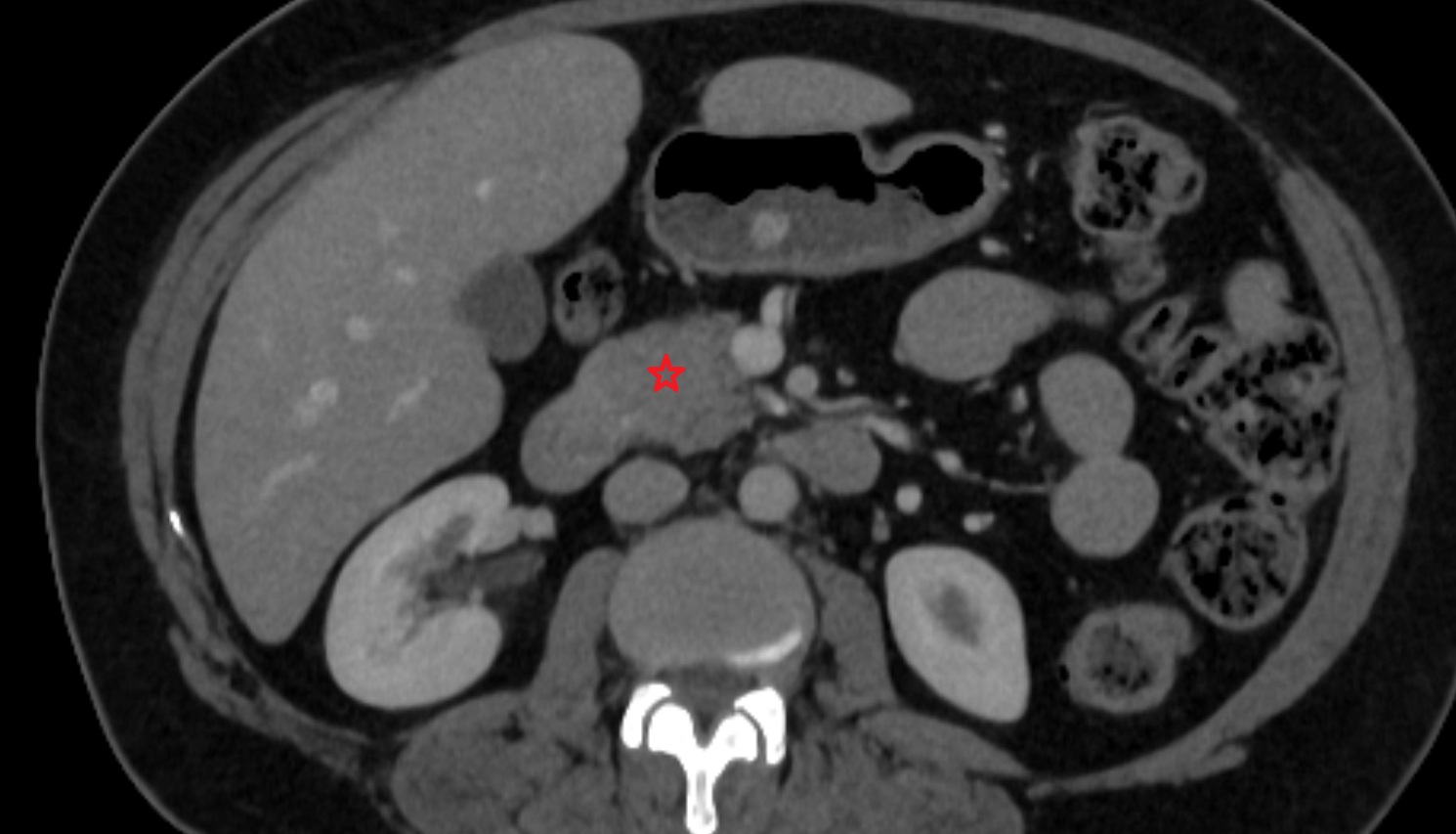 Head of pancreas  CT  axial  anatomy image-img-00000-00000