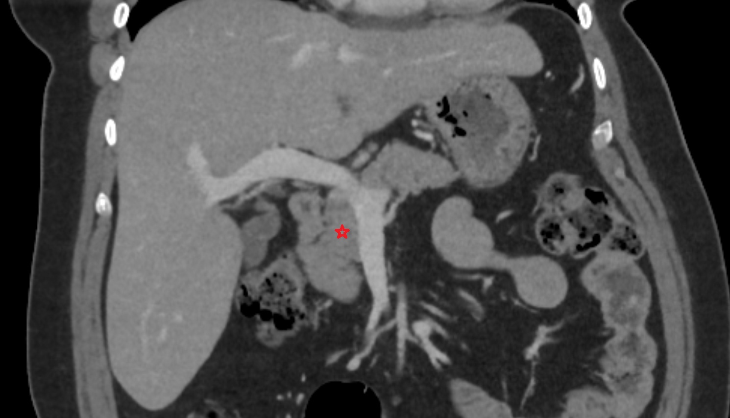 Head of pancreas  CT  coronal  anatomy image-img-00000-00000
