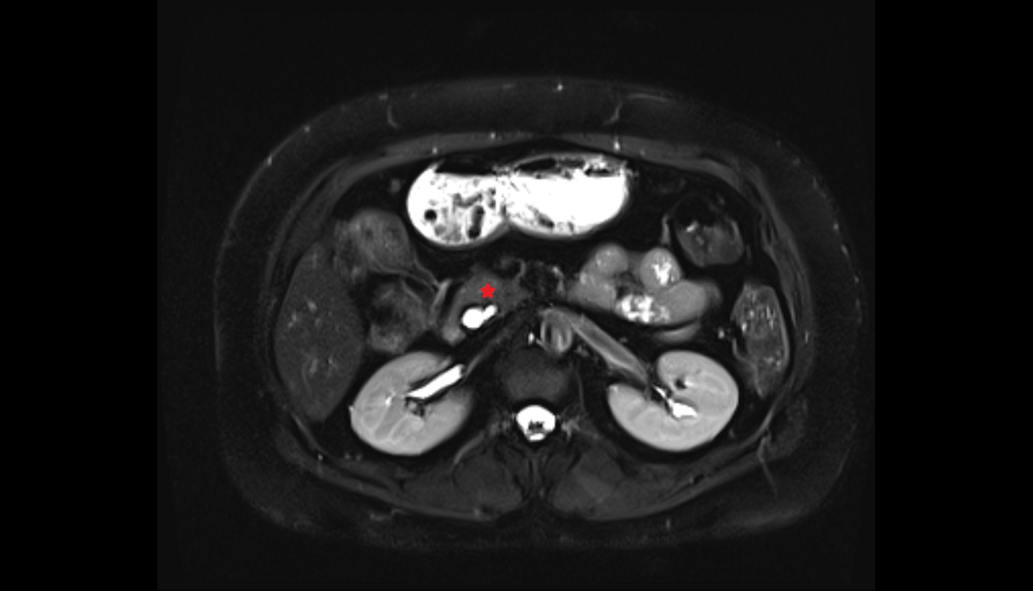 Head of pancreas  MRI axial  anatomy image-img-00000-00000