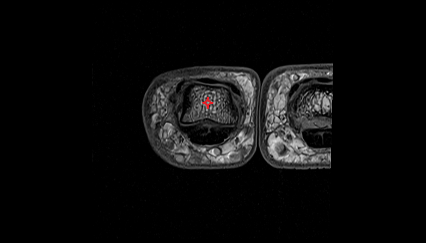 Head of phalanx of hand axial cross sectional anatomy 3T MRI AI enhanced radiology image-img-00000-00000