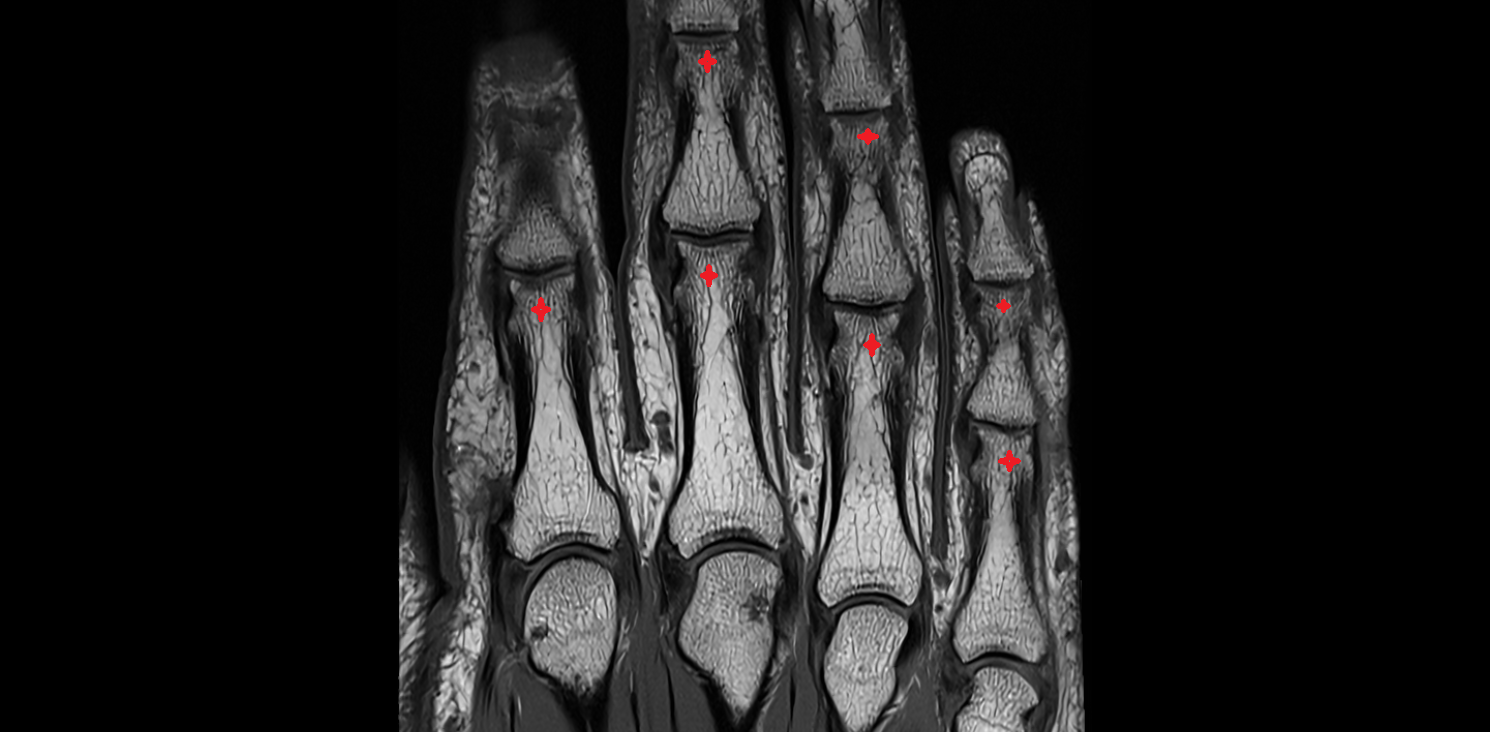 Head of phalanx of hand coronal cross sectional anatomy 3T MRI AI enhanced radiology image-img-00000-00000