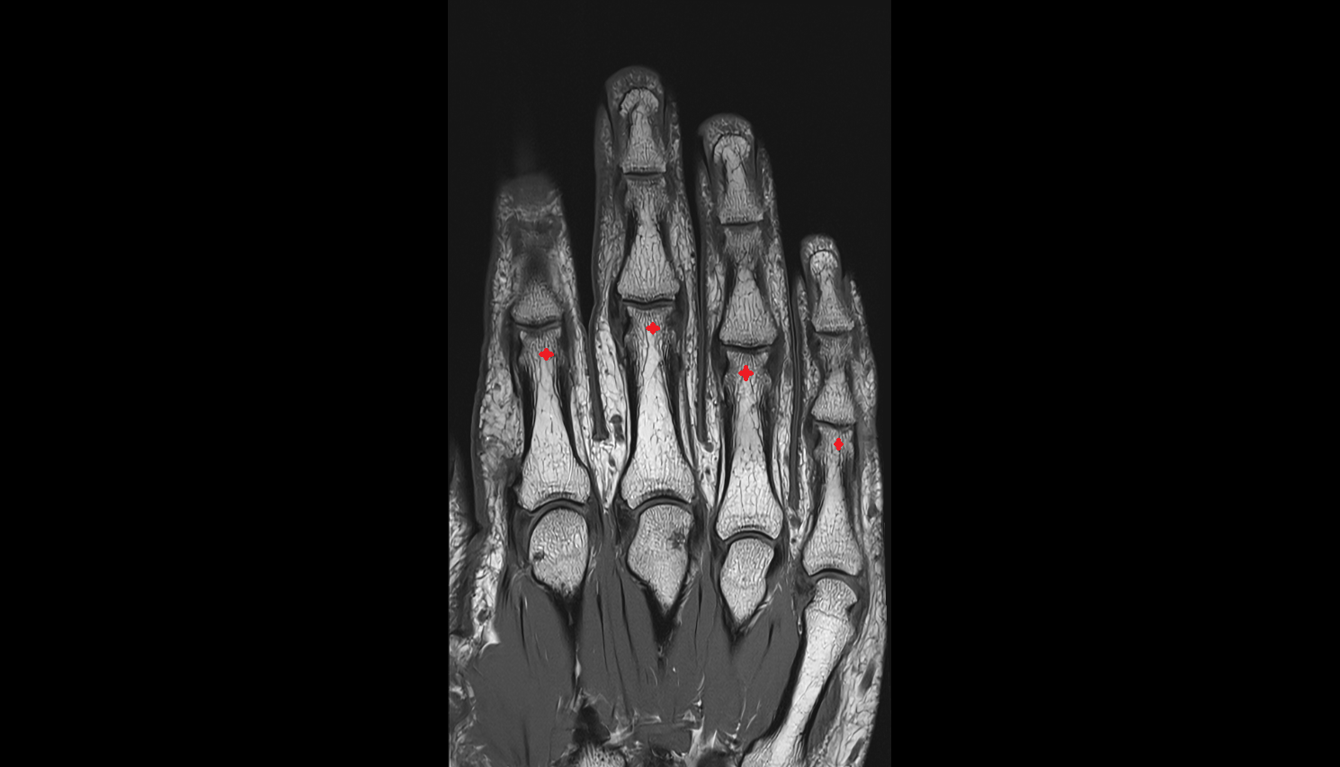 Head of proximal phalanx  MRI CORONAL image-img-00000-00000