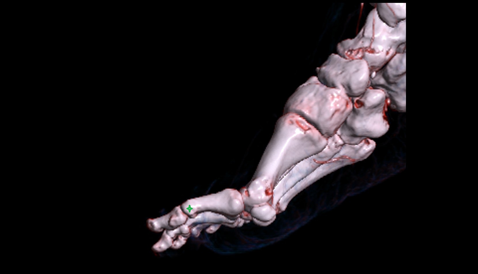 Head of proximal phalanx of great toe