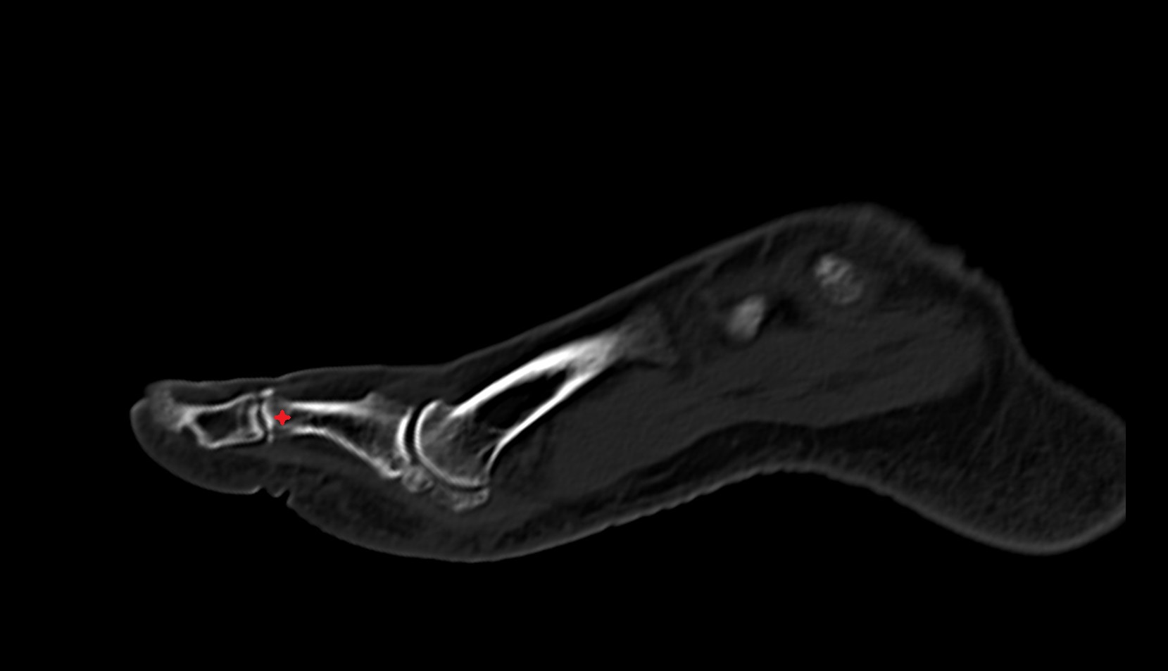 Head of proximal phalanx of great toe ct