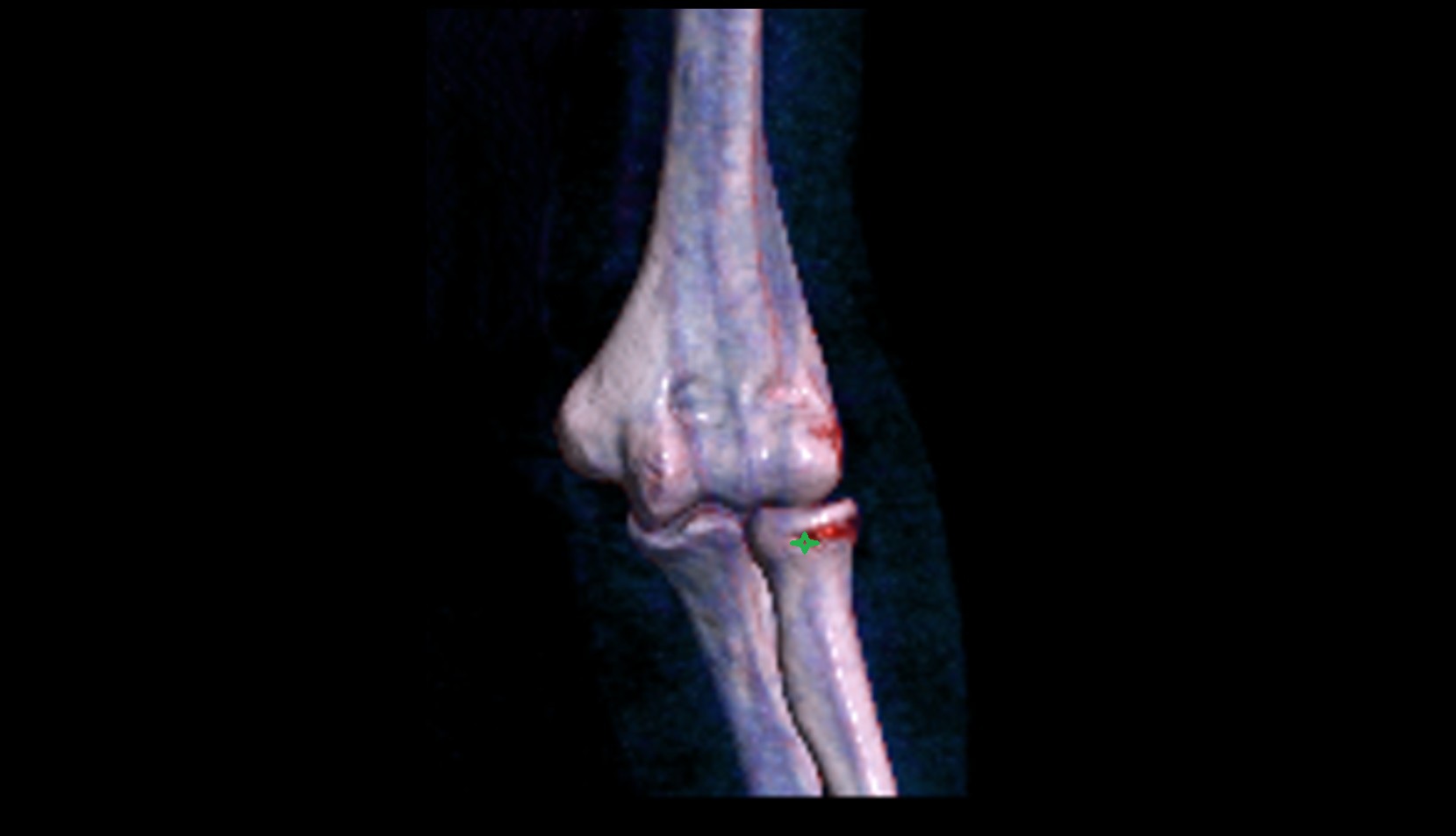 Head of radius 3d vrt image