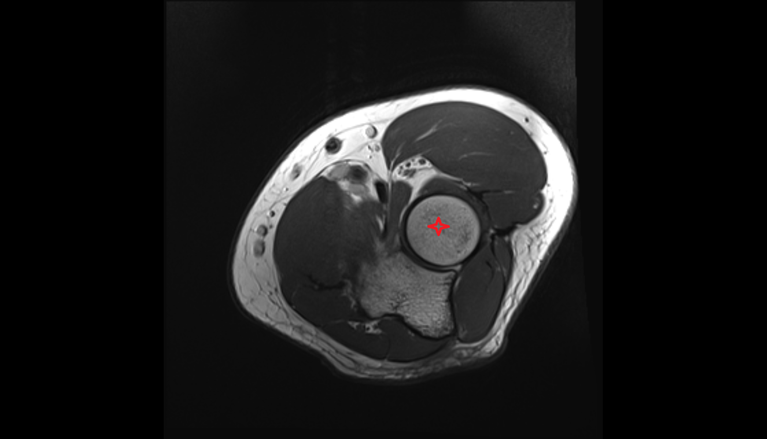 Head of radius axial cross sectional anatomy 3T MRI AI enhanced radiology image -img-00000-00000