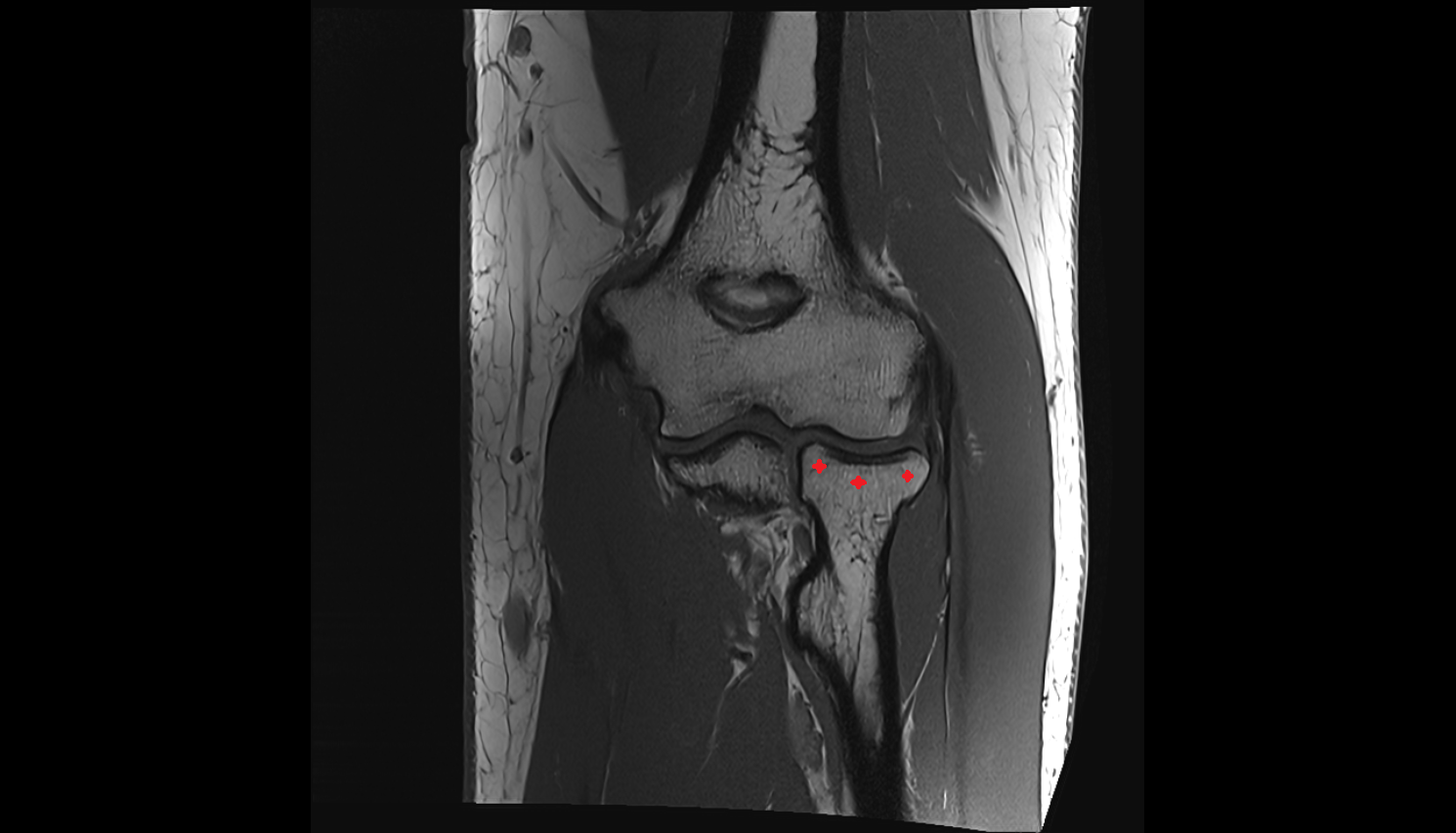 Head of radius coronal  cross sectional anatomy 3T MRI AI enhanced radiology image -img-00000-00000