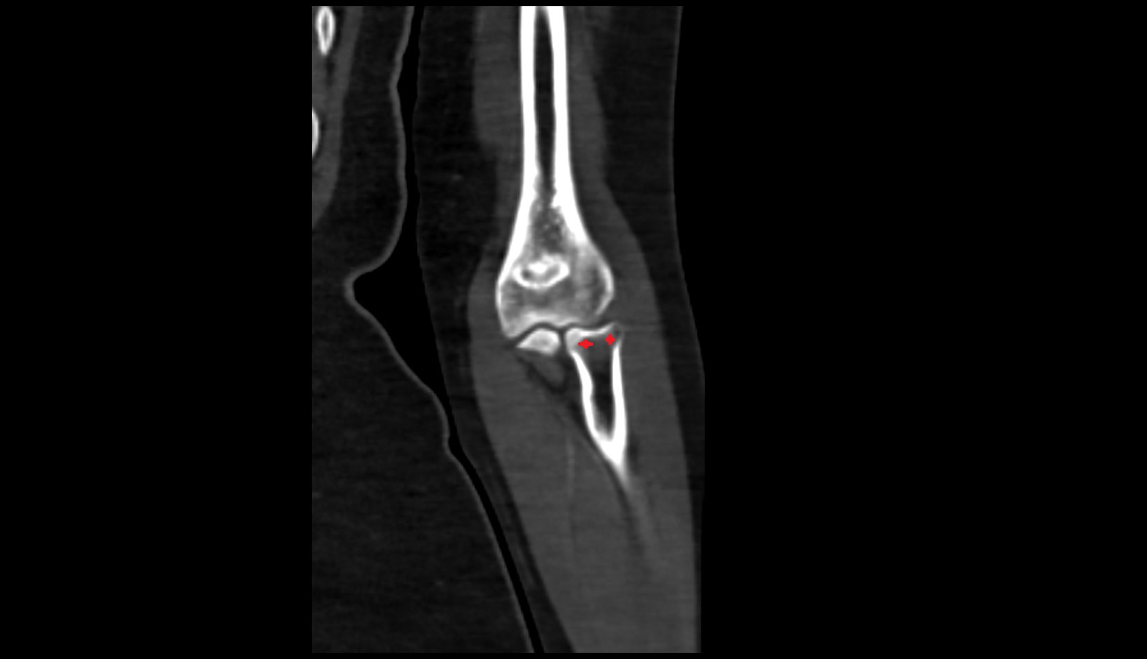 Head of radius ct image