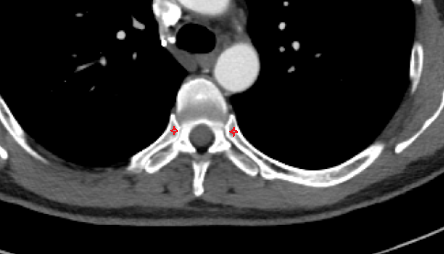 Head of rib CT Anatomy, Location and Imaging Appearance  -img-00000-00000