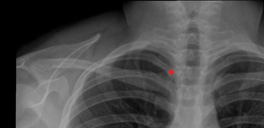 Head of rib x ray Anatomy, Location and Imaging Appearance  -img-00000-00000