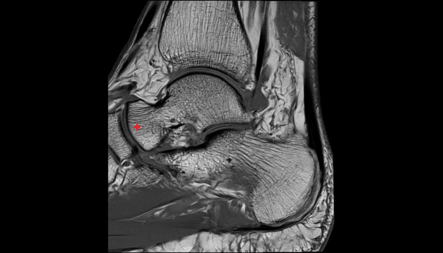 Head of talus  sag MRI cross sectional anatomy 3T MRI AI enhanced radiology image-img-00000-00000