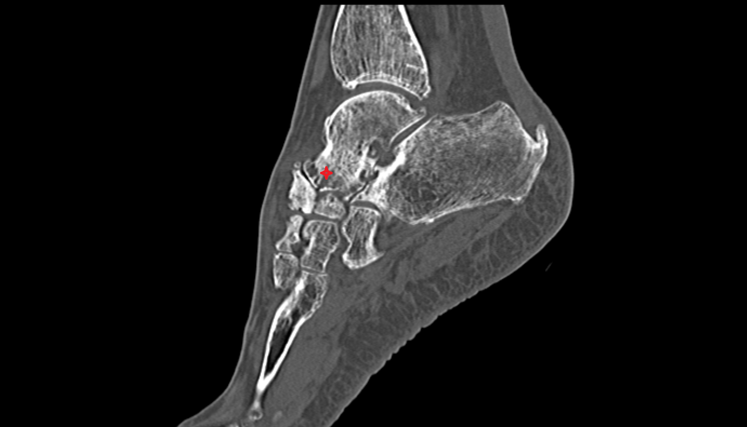 Head of talus  sagittal  CT cross sectional anatomy radiology image-img-00000-00000