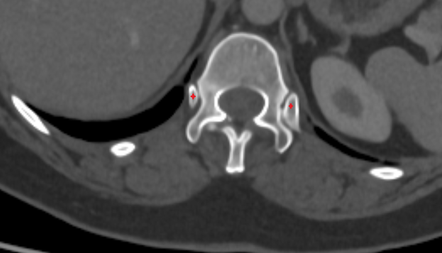 Head of twelfth rib CT AXIAL   anatomy  image-img-00000-00000