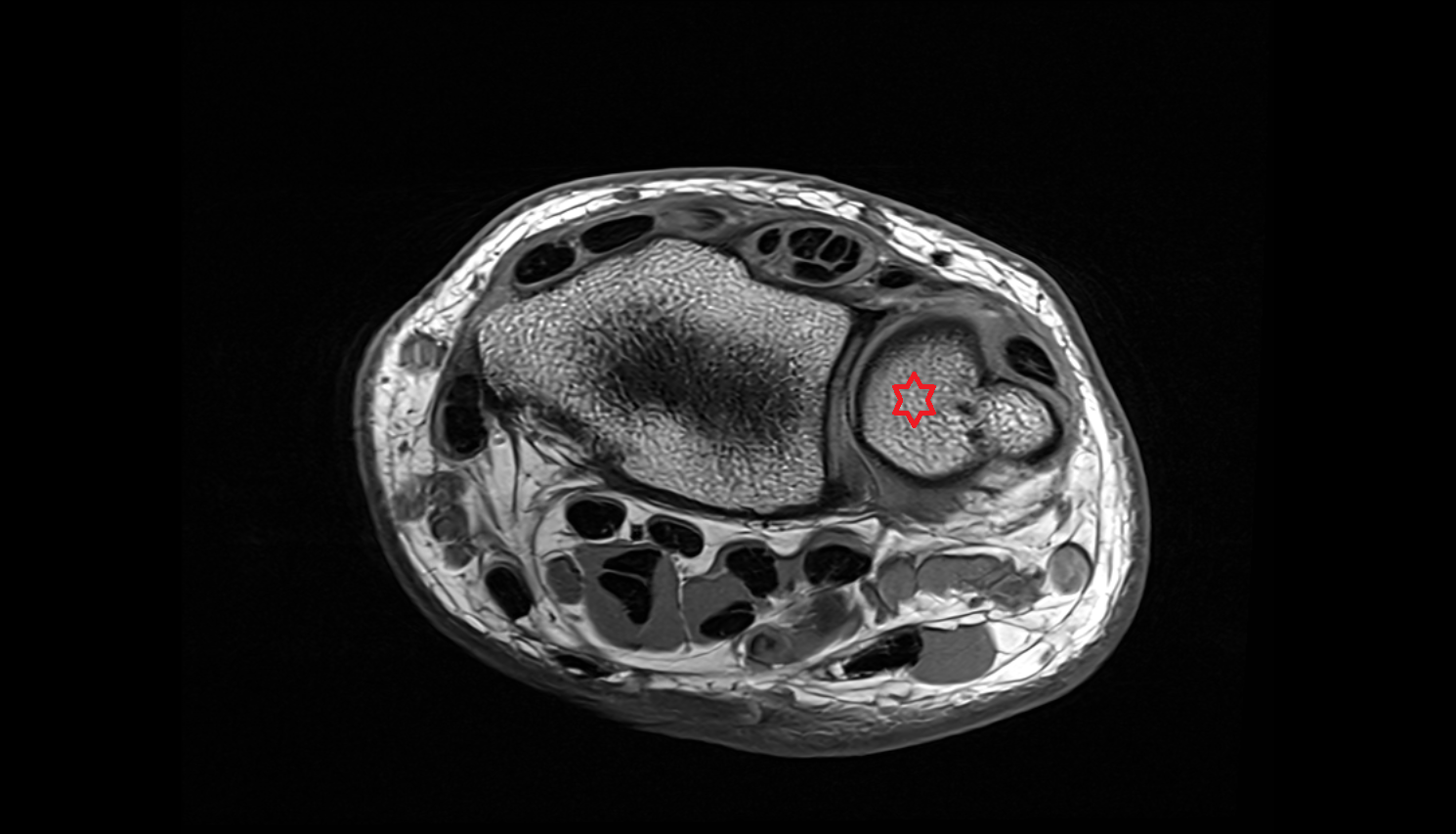 Head of ulna  AXIAL cross sectional anatomy 3T MRI AI enhanced radiology image-img-00000-00000