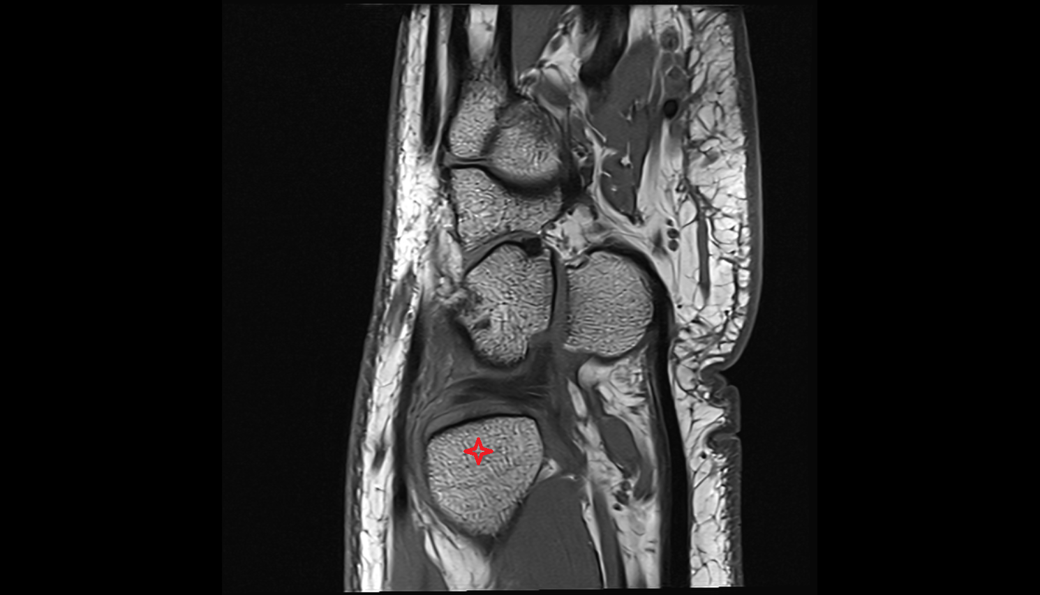 Head of ulna coronal cross sectional anatomy 3T MRI AI enhanced radiology image-img-00000-00000_00001