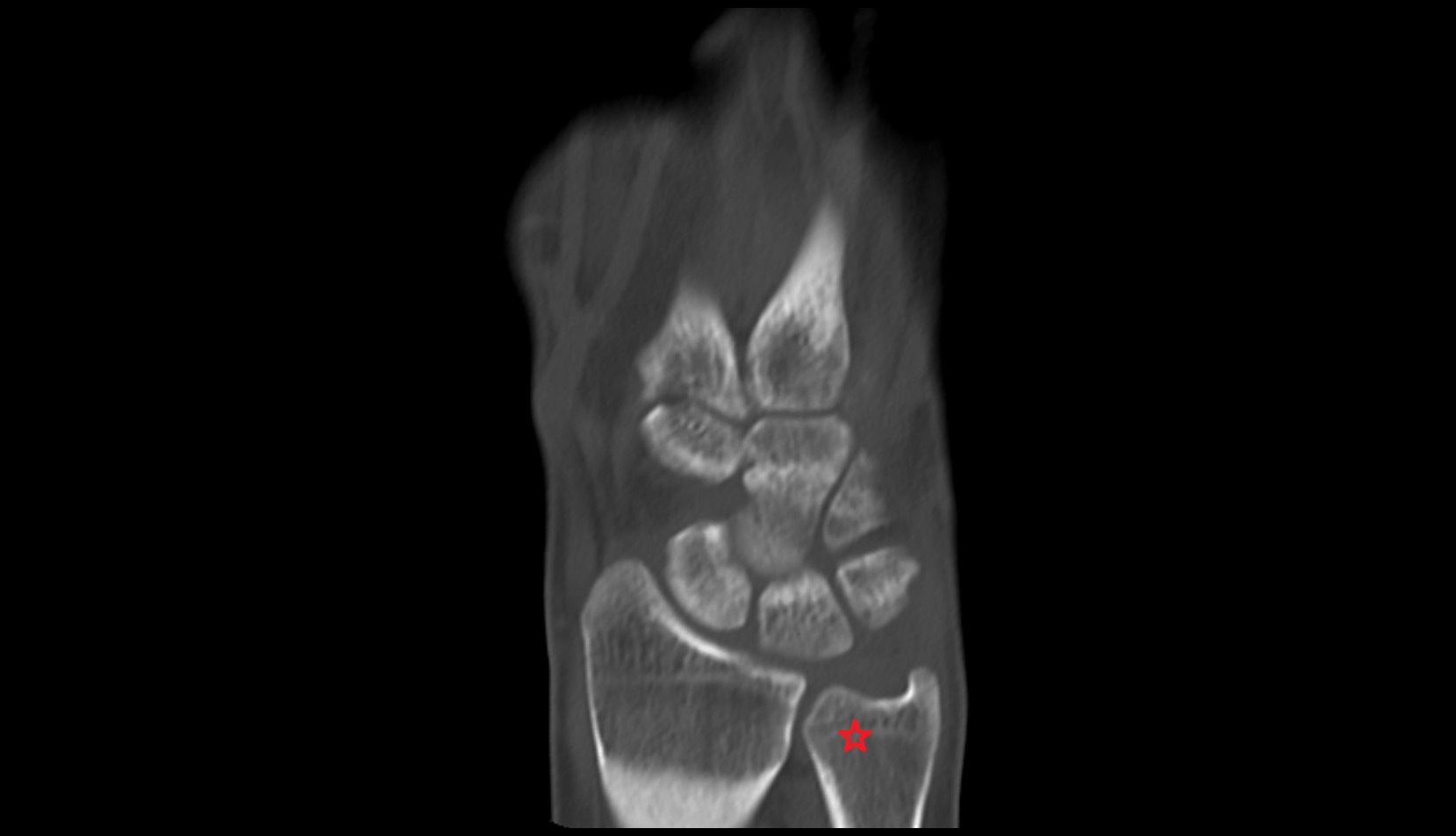 Head of ulna ct coronal